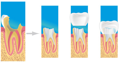 prothese dentaire la defense