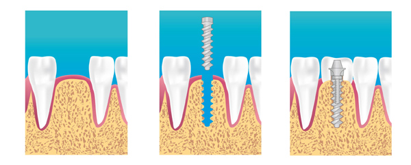 implant dentaire courbevoie la defense 
